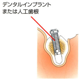 デンタルインプラントまたは人口歯根