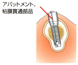 アバットメント、粘膜貫通部品