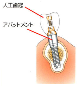 人口歯冠　アバットメント